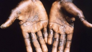 Maymun çiçeği virüsü: Dünyanın yeni korkusu oldu