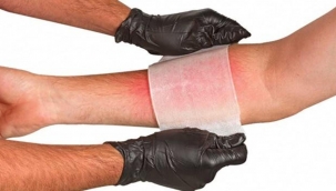 Yanıktan sonra su toplaması nasıl, kaç günde geçer? Su toplayan yanık patlarsa ne yapmalı?