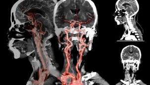 Dikkat! Mevsim geçişleri beyin kanaması riskini arttırıyor... Uzmanı açıkladı, özellikle sonbahar ve ilkbahara dikkat çekti